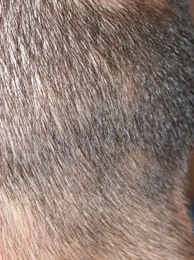 Alopecia areata after exciplex treatment - Dr Passeron