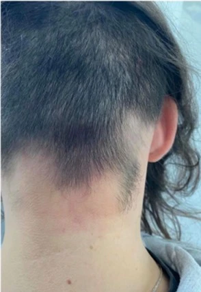 Alopecia areata after exciplex treatment - Dr Instytut Trychologii