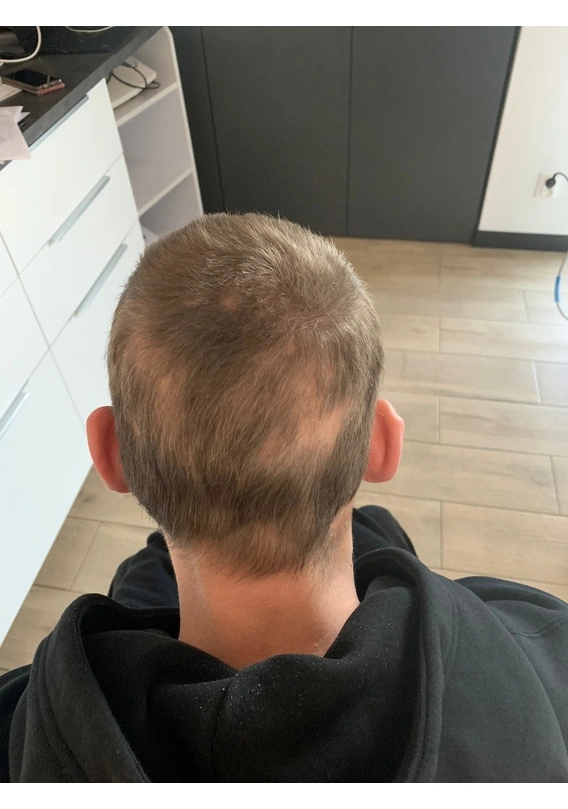 Alopecia areata after exciplex treatment - Dr Magdalena Kulik