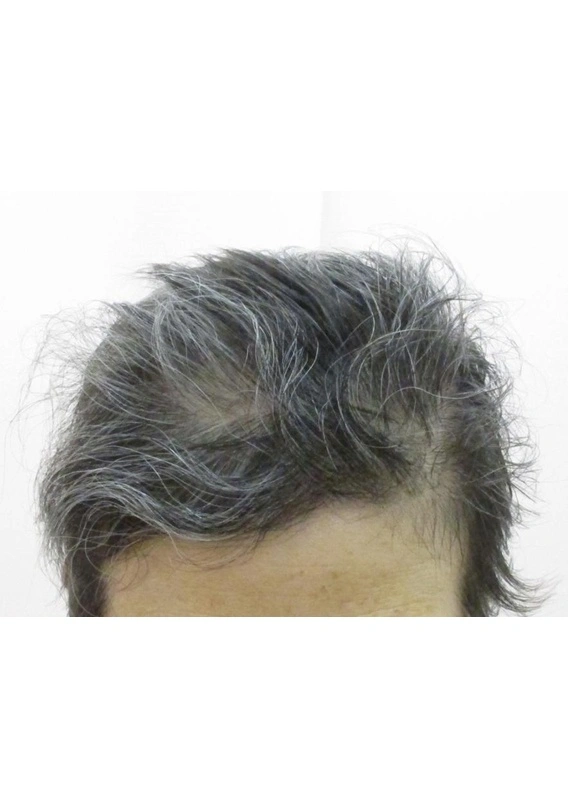 Alopecia areata after exciplex treatment - Dr. Masamichi Kakio