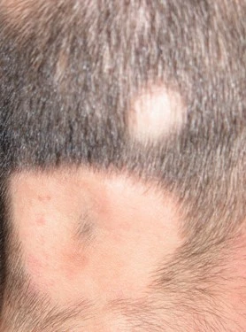 Alopecia areata before exciplex treatment - Dr Passeron