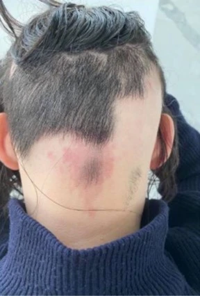 Alopecia areata before exciplex treatment - Dr Instytut Trychologii