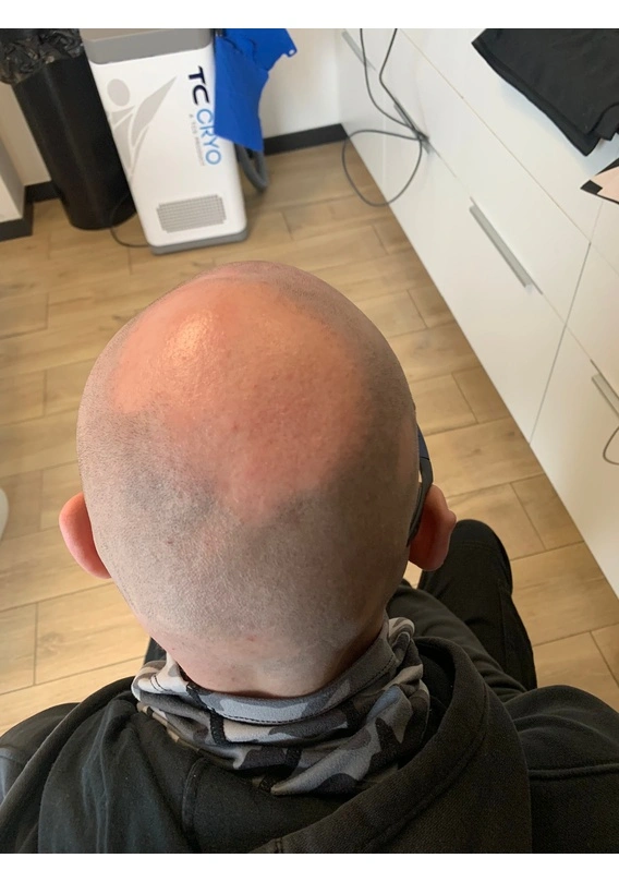 Alopecia areata before exciplex treatment - Dr Magdalena Kulik