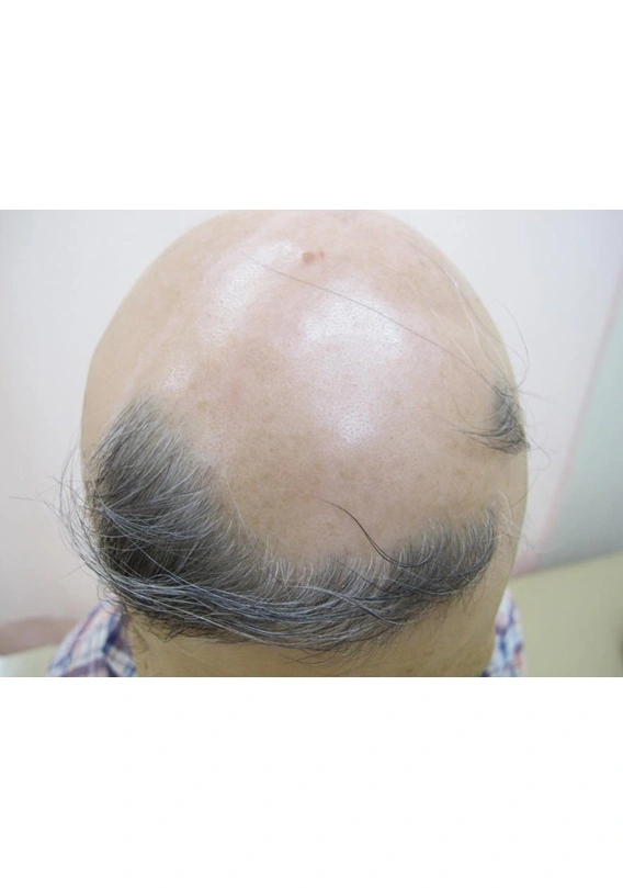 Alopecia areata before exciplex treatment - Dr. Masamichi Kakio