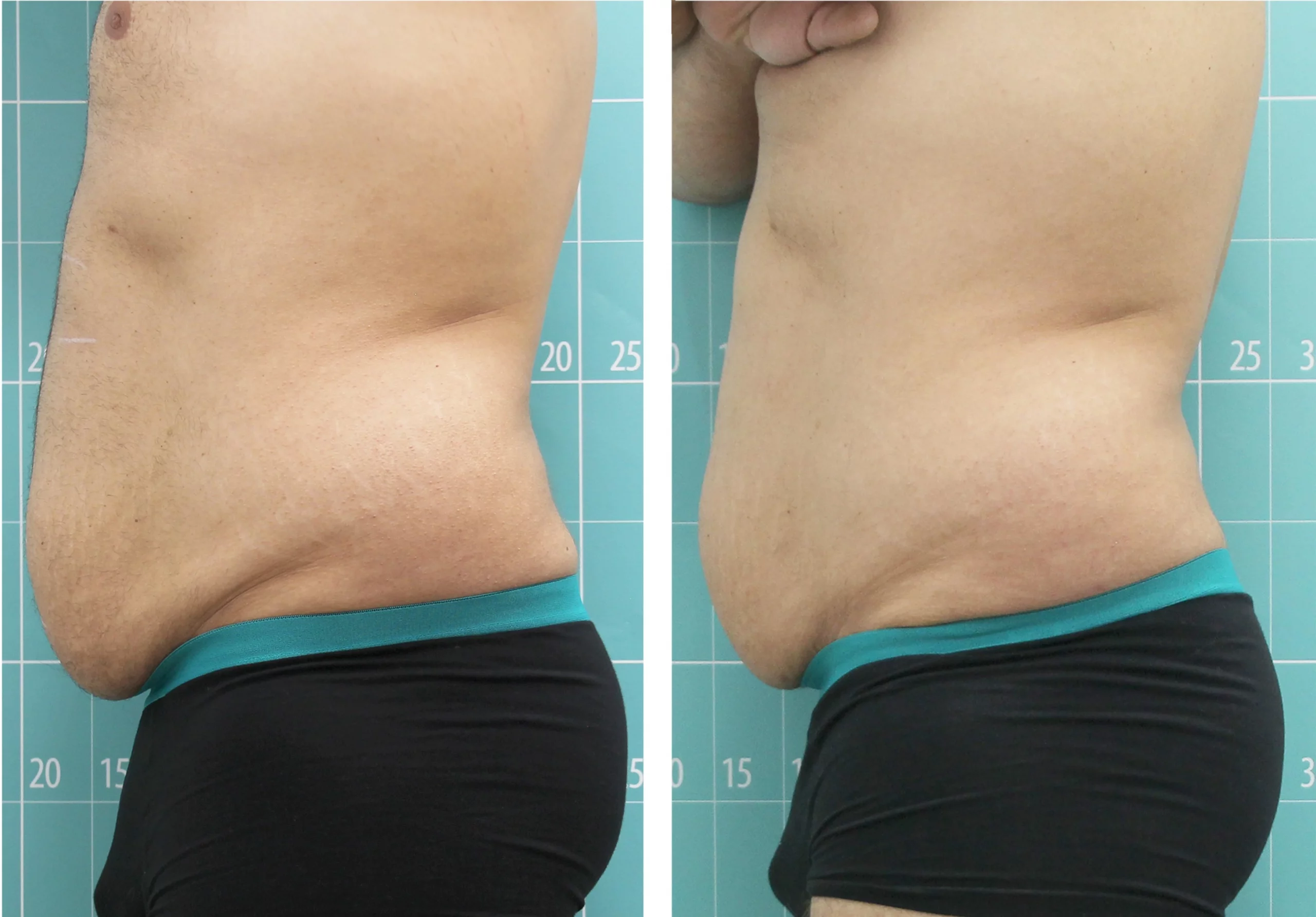 Criocuum before and after result 1