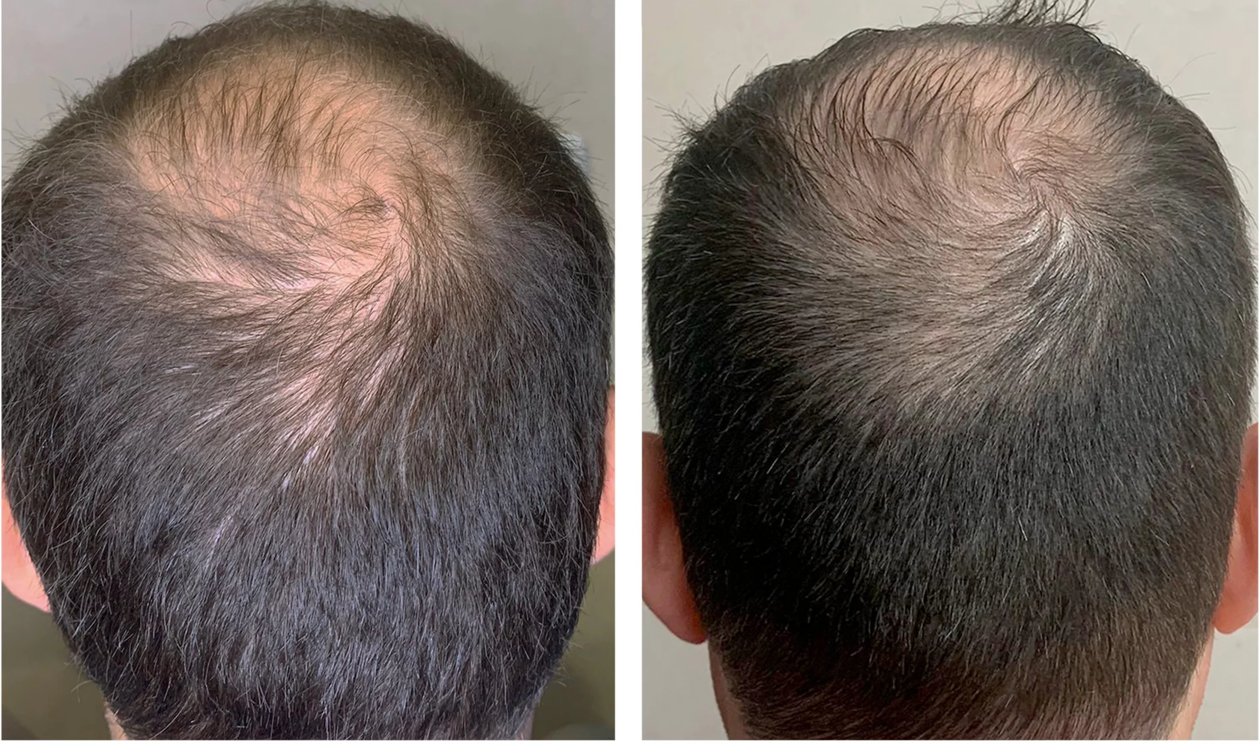 Symmed before and after result 1