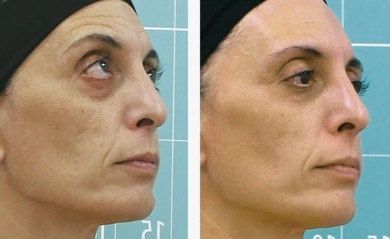 Symmed before and after result 2