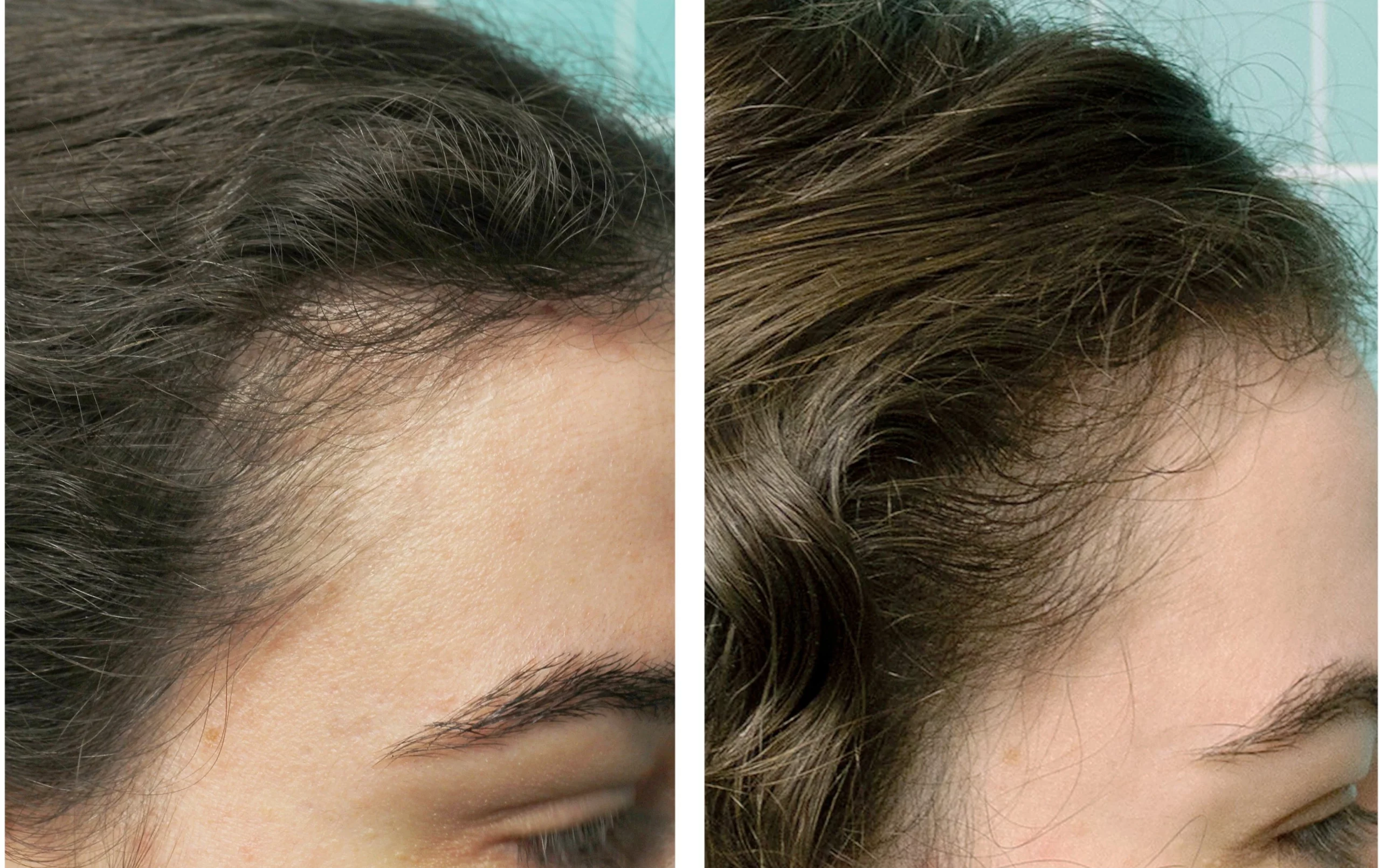Symmed before and after result 3