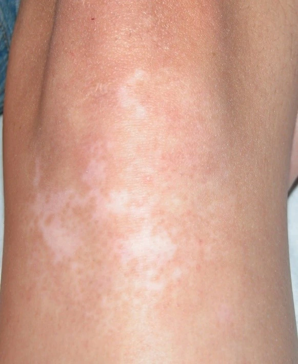 Vitiligo after exciplex treatment - Dr Passeron