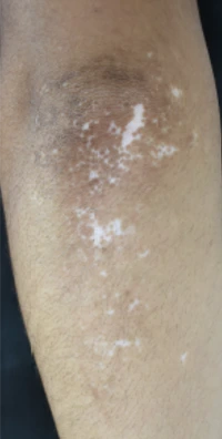 Vitiligo after exciplex treatment - Dr Rodriguez