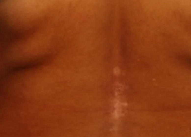 Vitiligo after exciplex treatment - Dr. Swapnil Shah