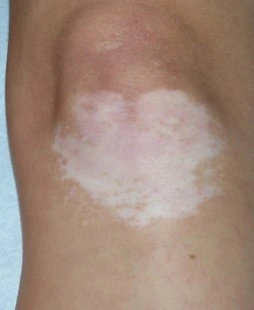Vitiligo before exciplex treatment - Dr Passeron