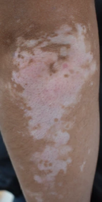 Vitiligo before exciplex treatment - Dr Rodriguez