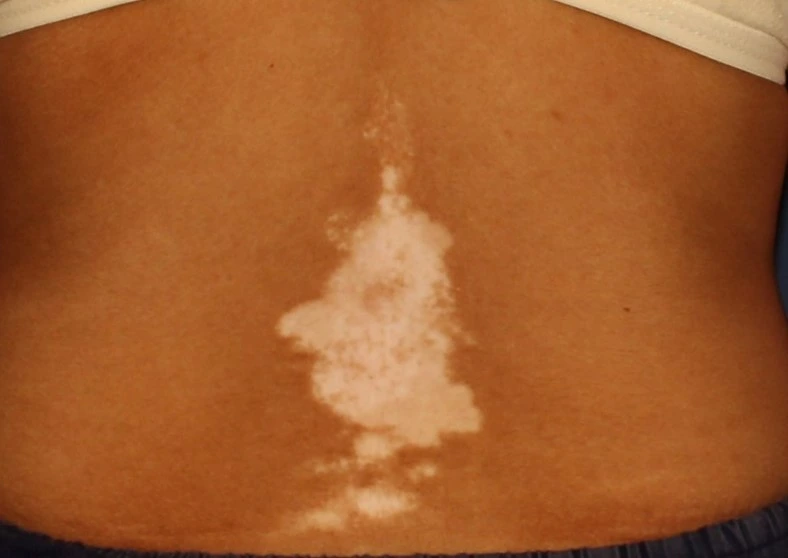 Vitiligo before exciplex treatment - Dr. Swapnil Shah
