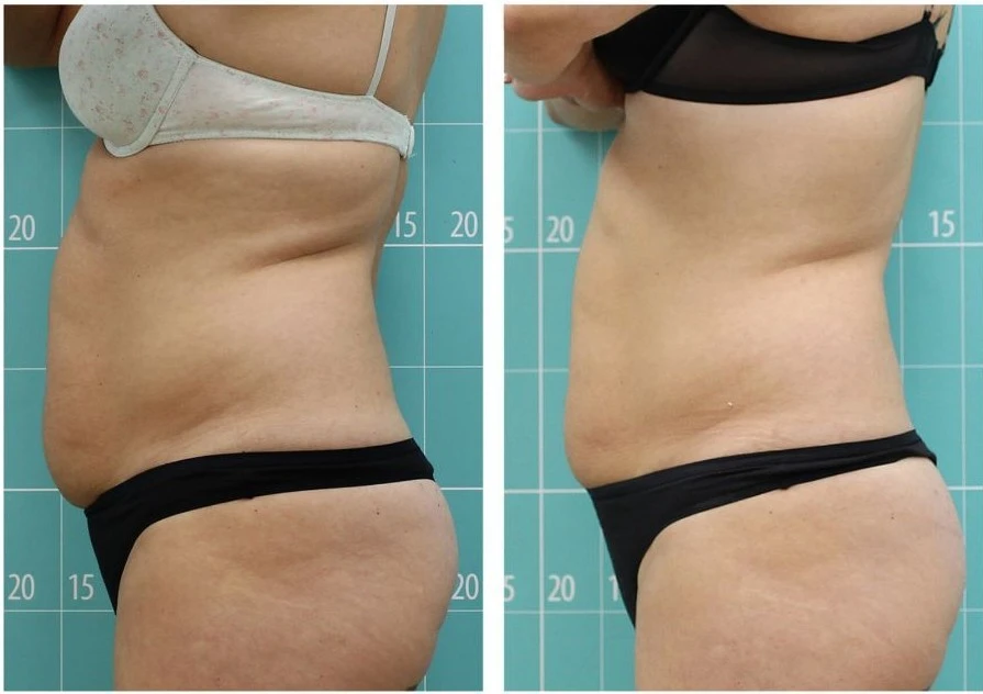 Vmat Pro before and after result 1