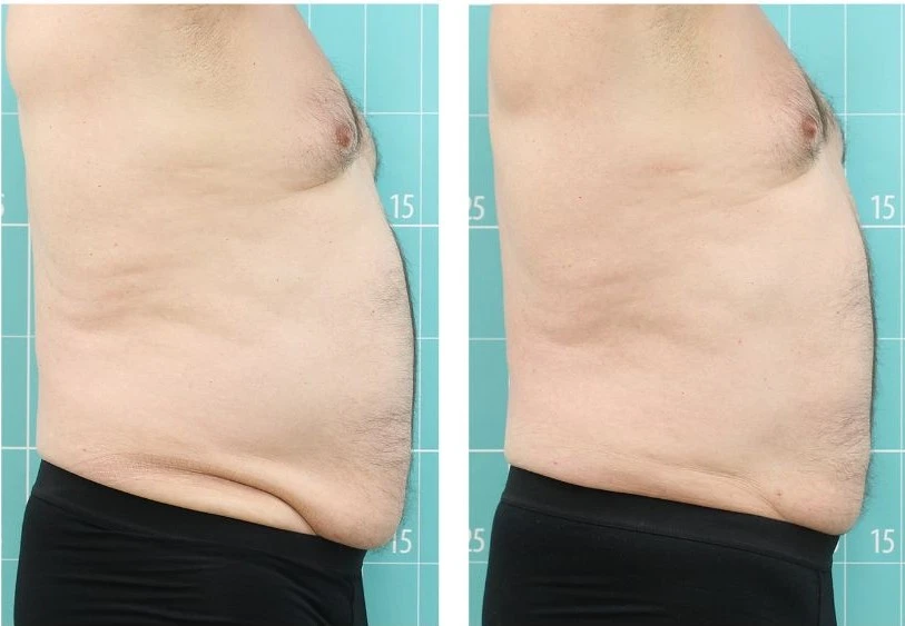 Vmat Pro before and after result 2