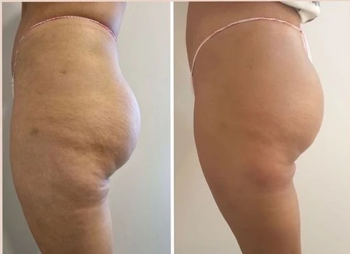 Vmat Pro before and after result 3