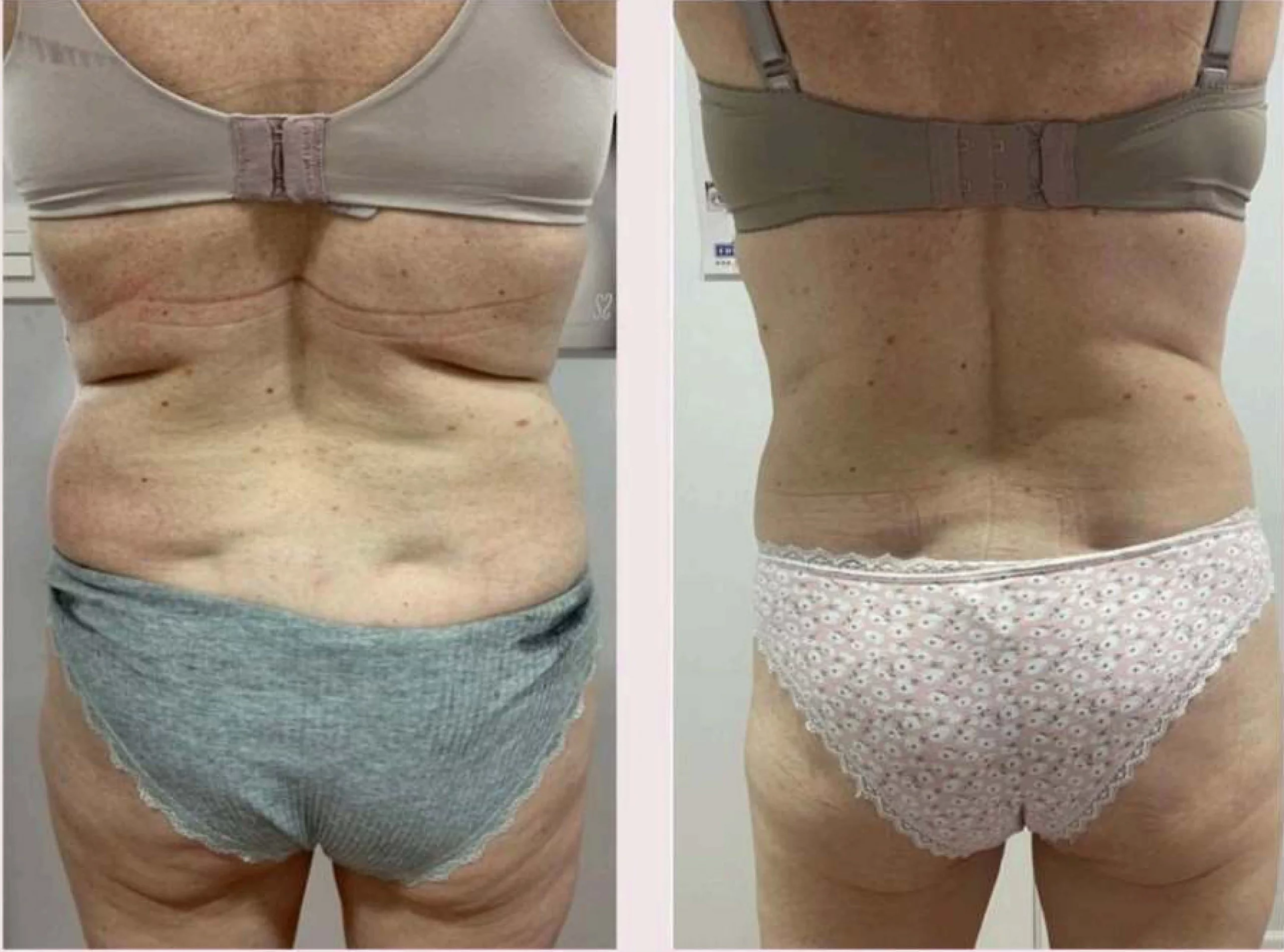 Zionic before and after result 2