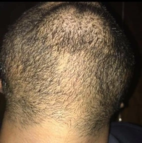 Alopecia areata after exciplex treatment - Astera Clinic