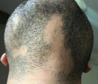 Alopecia areata before exciplex treatment - Astera Clinic
