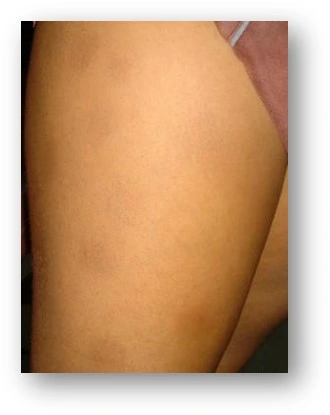 Atopic dermatitis after exciplex treatment - Dr Swapnil Shah