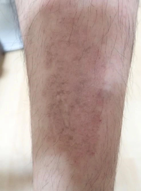 Atopic dermatitis after exciplex treatment - Dr Yasuyuki Suzuki