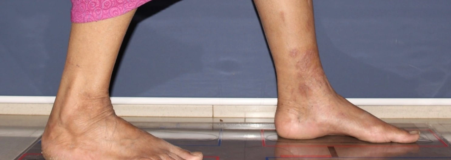 Atopic dermatitis after exciplex treatment - Dr Shah