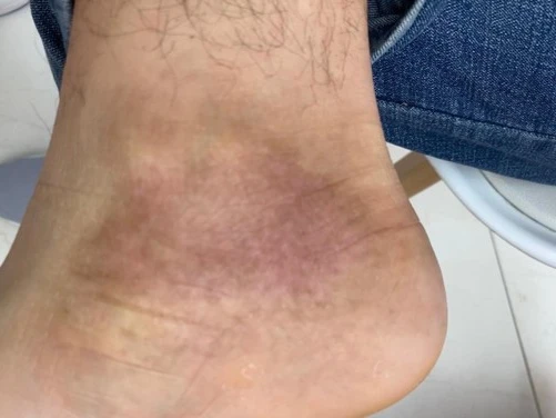 Atopic dermatitis after exciplex treatment - Dr Alina Salman
