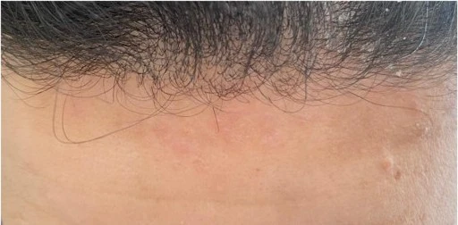 Atopic dermatitis after exciplex treatment - Dr Alina Salman