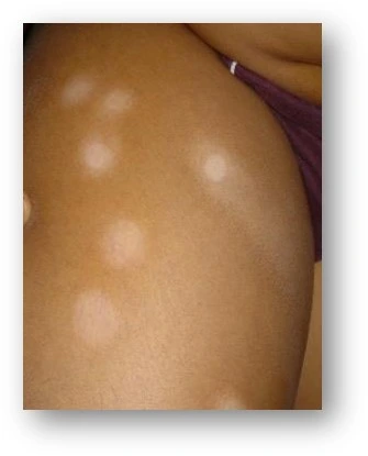 Atopic dermatitis before exciplex treatment - Dr Swapnil Shah
