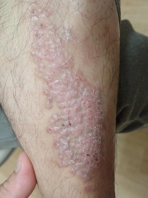 Atopic dermatitis before exciplex treatment - Dr Yasuyuki Suzuki