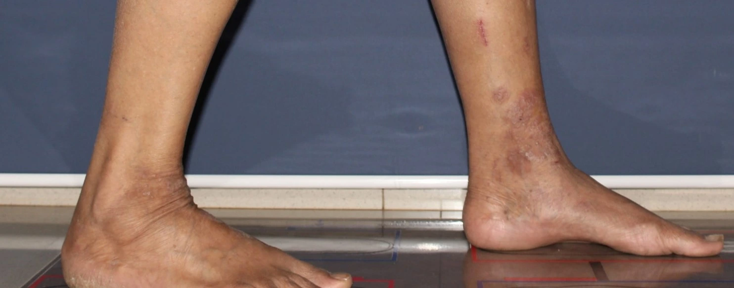 Atopic dermatitis before exciplex treatment - Dr Shah