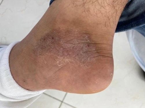 Atopic dermatitis before exciplex treatment - Dr Alina Salman