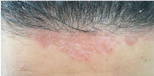 Atopic dermatitis before exciplex treatment - Dr Alina Salman