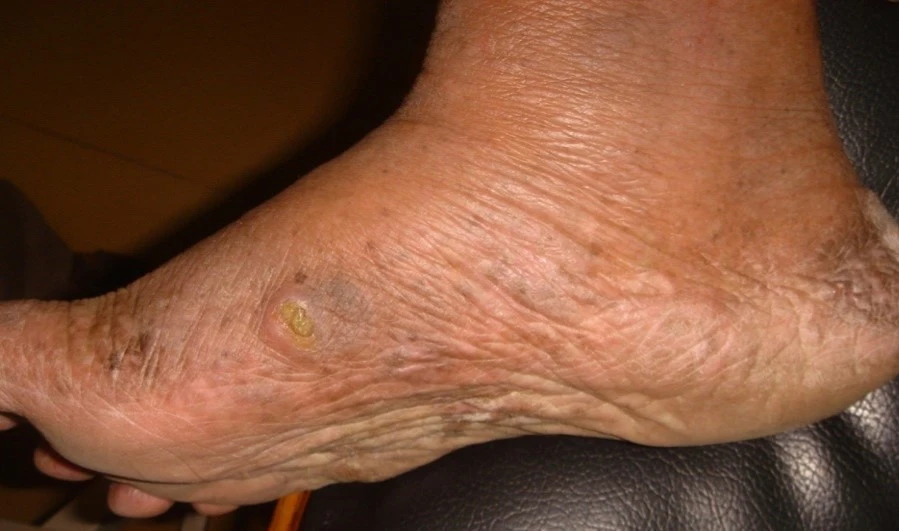 Mycosis fungoides after exciplex treatment - Dr Sakhiya