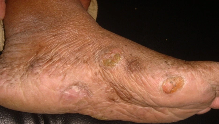 Mycosis fungoides after exciplex treatment - Dr Sakhiya