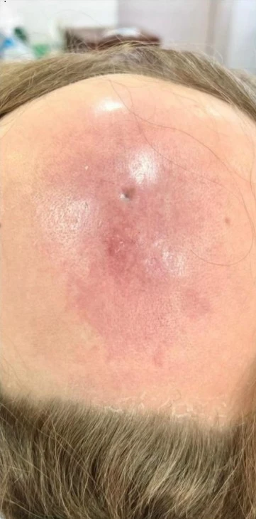Mycosis fungoides after exciplex treatment - Dr Armaghan Zarea