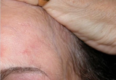 Mycosis fungoides after exciplex treatment - Pr Thierry Passeron
