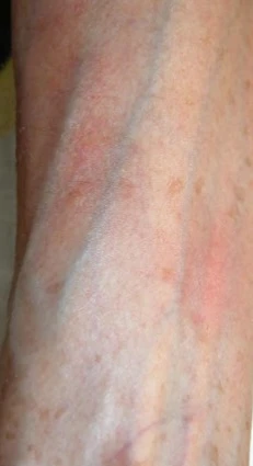 Mycosis fungoides after exciplex treatment - Pr Thierry Passeron
