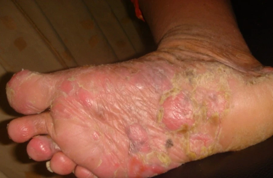 Mycosis fungoides before exciplex treatment - Dr Sakhiya