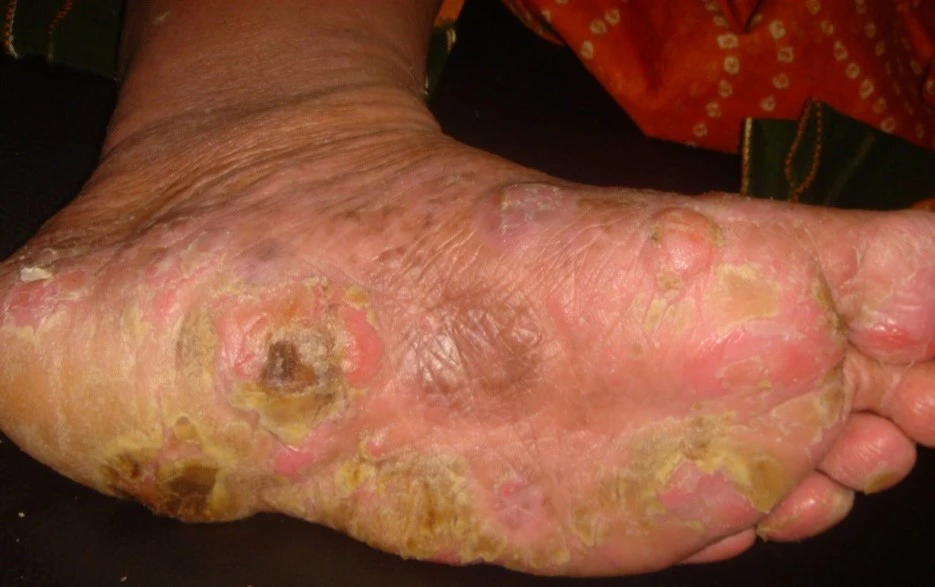 Mycosis fungoides before exciplex treatment - Dr Sakhiya