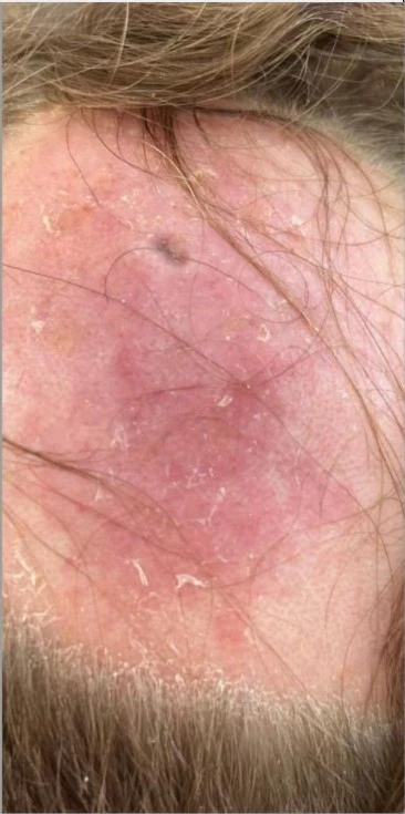 Mycosis fungoides before exciplex treatment - Dr Armaghan Zarea
