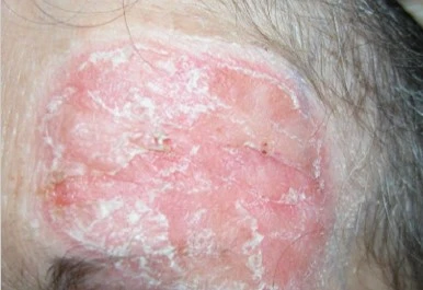 Mycosis fungoides before exciplex treatment - Pr Thierry Passeron