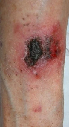 Mycosis fungoides before exciplex treatment - Pr Thierry Passeron