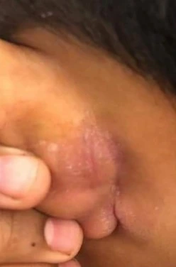 Psoriasis after exciplex treatment - Wow Clinic Skin & Beauty