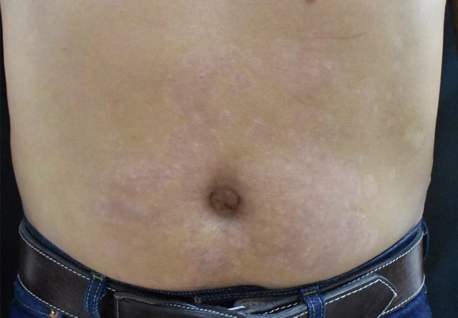 Psoriasis after exciplex treatment - Dr Dalia Rodriguez