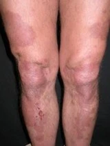 Psoriasis after exciplex treatment - Leone