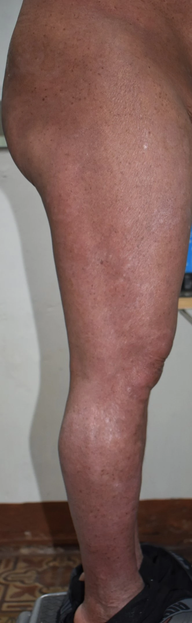 Psoriasis after exciplex treatment - Dr Letona