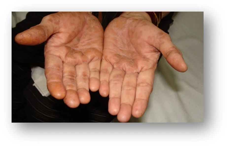 Psoriasis after exciplex treatment - Dr Swapnil Shah