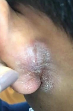 Psoriasis before exciplex treatment - Wow Clinic Skin & Beauty
